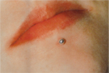 Piercingschden 6.JPG (32226 Byte)